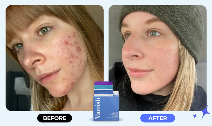 Before After ad1 1