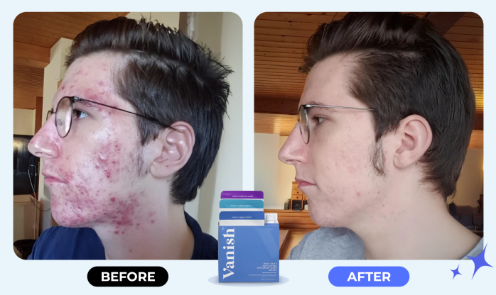 Before After ad2 1
